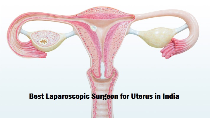 Best Laparoscopic Surgeon for Uterus in India